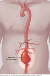 Aneurisma de aorta abdominal aneurisma