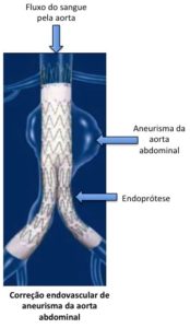 Aneurisma endoprótese endovascular