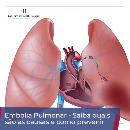 Embolia Pulmonar – Saiba o Que Causa e Como Prevenir