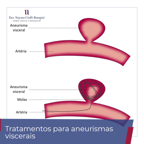 Tratamentos para aneurismas viscerais