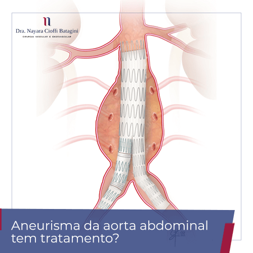 Aneurisma da aorta abdominal tem tratamento?