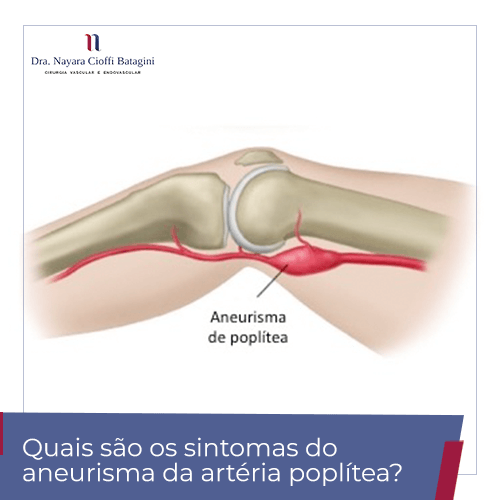 Quais são os sintomas do aneurisma da artéria poplítea?