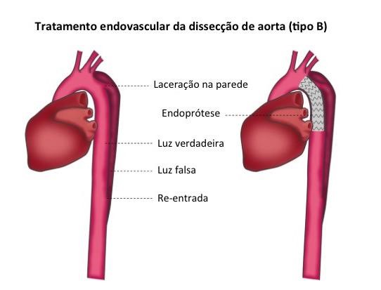 dissecção da aorta