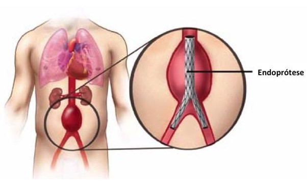 Aneurisma da aorta abdominal