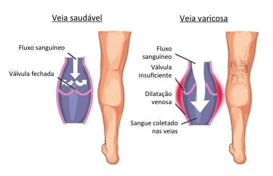 Quais são as causas das varizes?