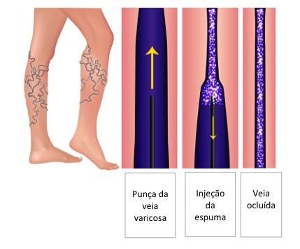 Escleroterapia com Espuma img interna