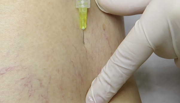Escleroterapia vasinhos