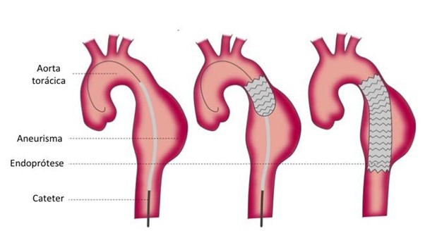 Tratamento com a técnica endovascular