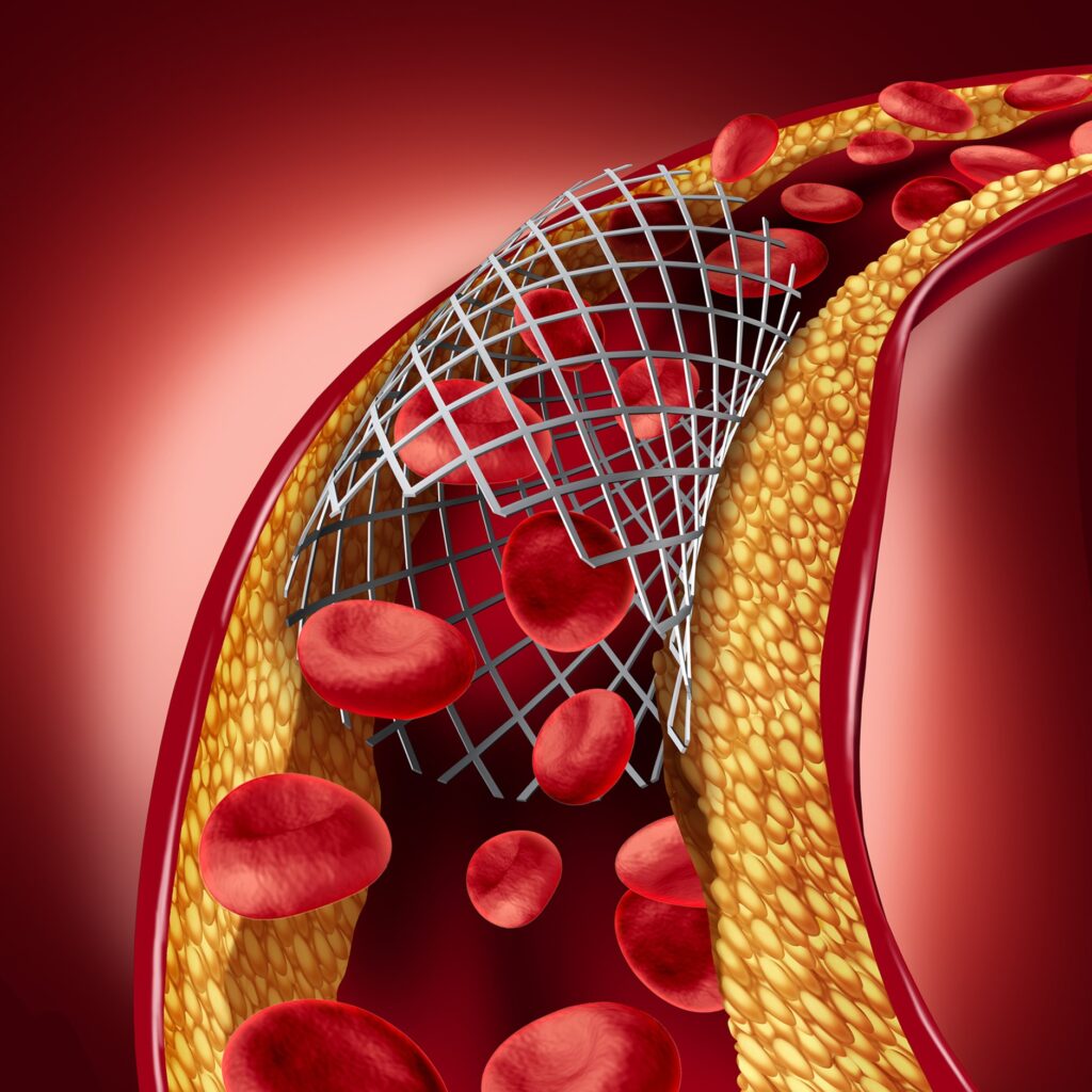 O que é a angioplastia arterial