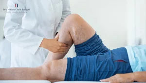 Perna com coloração amarronzada e escurecida na região distal causada por dermatite ocre — consequência da insuficiência venosa crônica