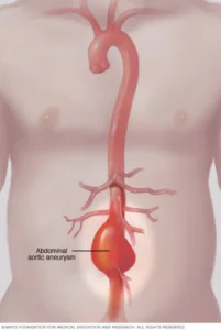 Aneurisma de aorta abdominal aneurisma
