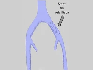 Síndrome de May-Thurner/Cockett - Entenda a Doença e Saiba Como Tratar Síndrome
