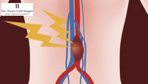 Jovens Podem Ter Aneurisma da Aorta Abdominal
