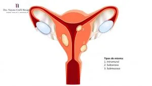 Tratamento de Embolização para Mioma