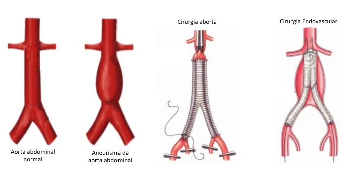Aneurisma da aorta abdominal tem tratamento? Aneurisma da aorta abdominal tem tratamento?