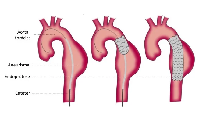 Aneurisma da Aorta Torácica — Tratamento Endovascular Ilustração do aneurisma da aorta torácica e posicionamento da endoprótese por via endovascular
