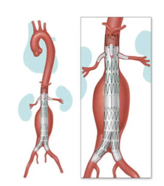 Aneurisma Toraco-Abdominal — Endoprótese Fenestrada FEVAR Endoprótese fenestrada (FEVAR) para tratamento do aneurisma da aorta toraco-abdominal com preservação das artérias viscerais