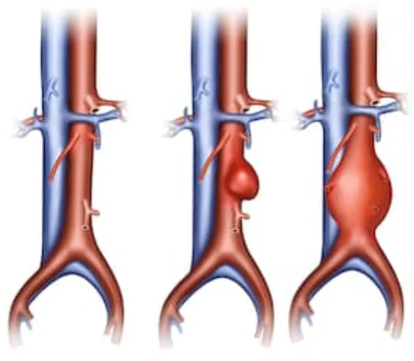 Aneurisma da Aorta Abdominal — Tratamento Endovascular Ilustração do aneurisma da aorta abdominal e tratamento com endoprótese vascular