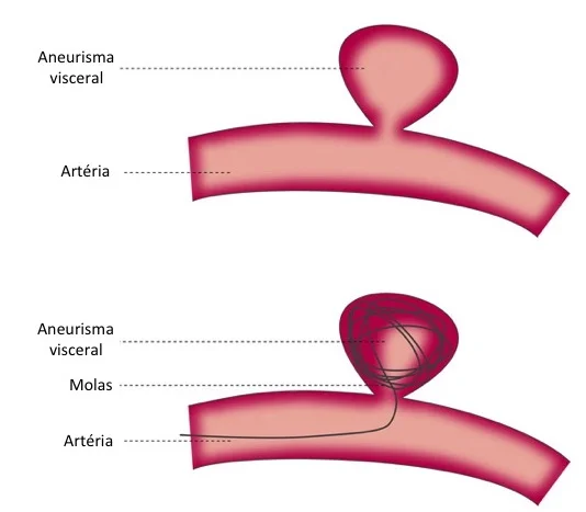 Tratamento Endovascular de Aneurisma Visceral — Embolização com Molas Ilustração comparativa do aneurisma visceral sem tratamento e após embolização com molas por técnica endovascular